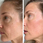 Professionell dermapen + 4 gratis gåvor