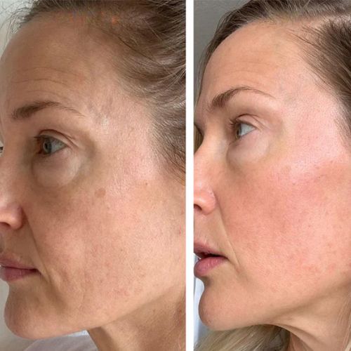 Professionell dermapen + 4 gratis gåvor