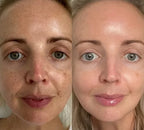 Professionell dermapen + 4 gratis gåvor