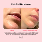 Professionell dermapen + 4 gratis gåvor