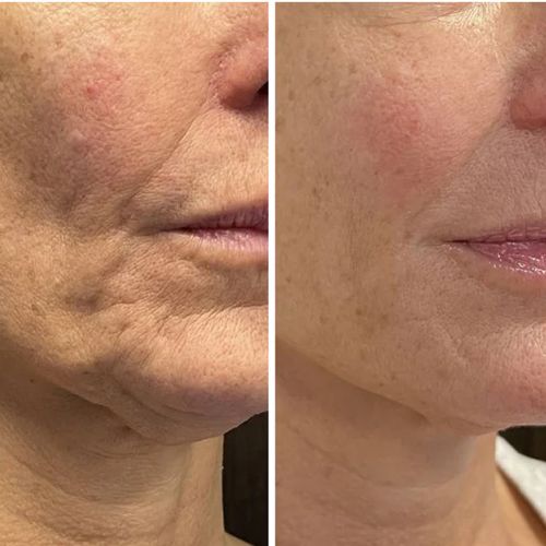 Professionell dermapen + 4 gratis gåvor