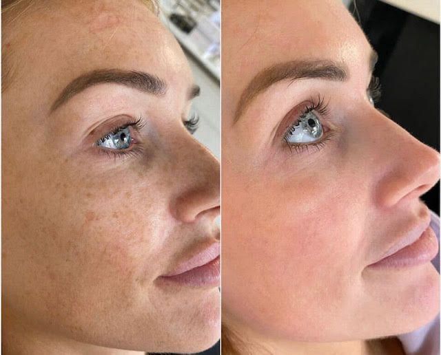Professionell dermapen + 4 gratis gåvor