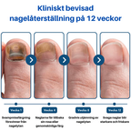 OnlyClear™- Laser mot nagelsvamp