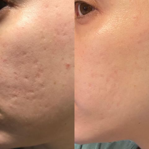 NOVA™ – Silikonförband 1+1 Gratis
